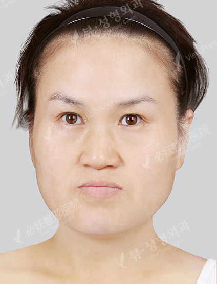 Nano Two Jaw+Natural Vline+Cheekbone Implant (2 Months) — Before