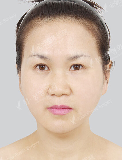 Nano Two Jaw+Natural Vline+Cheekbone Implant (2 Months) — After