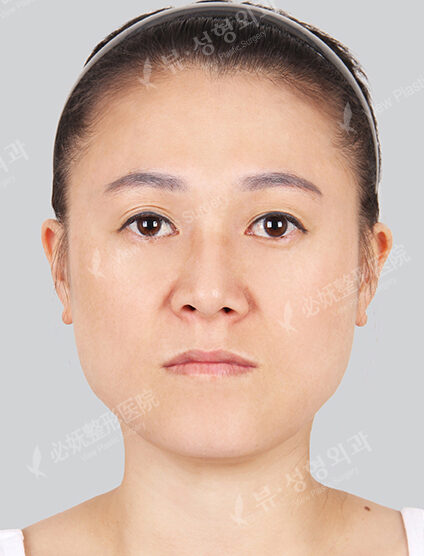 Nano Two Jaw+Natural Vline (4 Months ) — Before