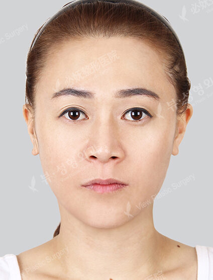 Nano Two Jaw+Natural Vline (4 Months ) — After