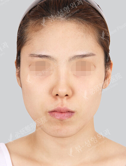 Protruding Mouth (Braces)+ Natural Line (Angular+Front Chin)+ Cheekbone_6 Months — Before