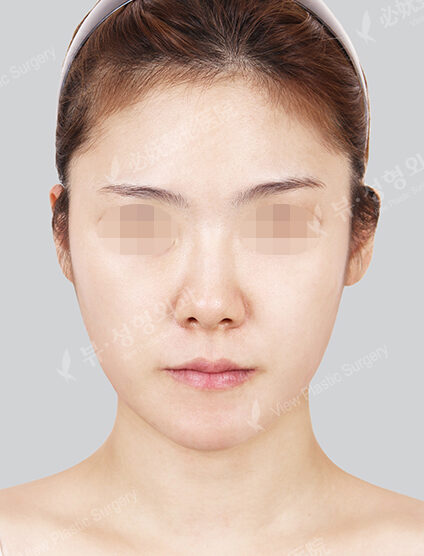 Protruding Mouth (Braces)+ Natural Line (Angular+Front Chin)+ Cheekbone_6 Months — After