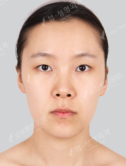 Nano Two Jaw+Natural Line (Angular+Front Chin)+ Burial+Epicanthoplasty_3 Months — Before