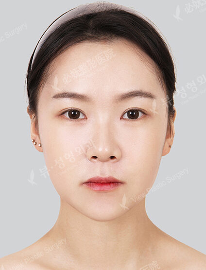 Nano Two Jaw+Natural Line (Angular+Front Chin)+ Burial+Epicanthoplasty_3 Months — After
