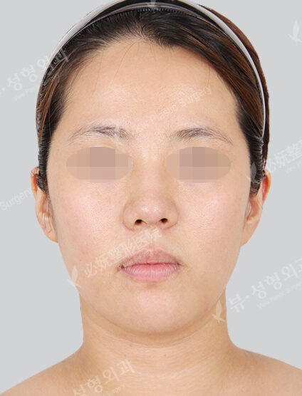 Nano Two Jaw+Natural Vline+Zygoma Reduction (3 Months) — Before