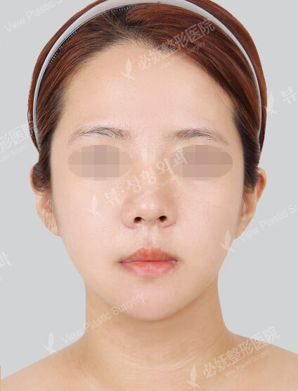 Nano Two Jaw+Natural Vline+Zygoma Reduction (3 Months) — After