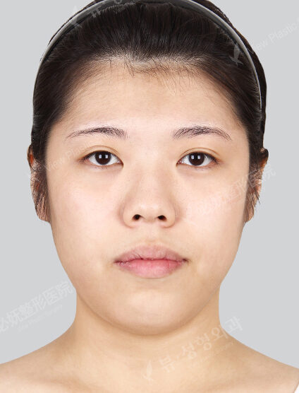 Protruding Mouth+Natural Vline+Zygoma Reduction+Forehead Implant (15 Months) — Before