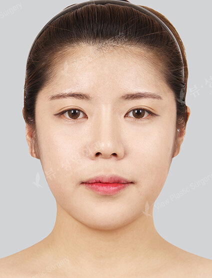 Protruding Mouth+Natural Vline+Zygoma Reduction+Forehead Implant (15 Months) — After
