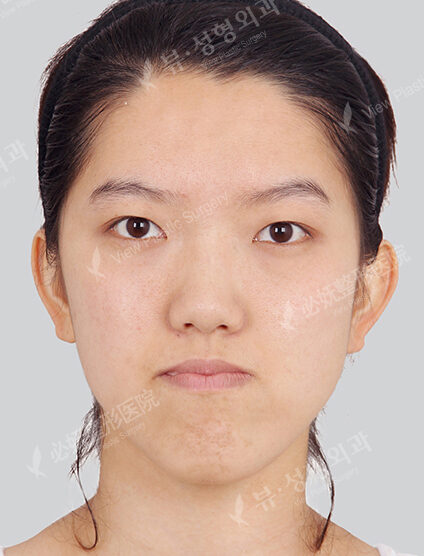 Nano Two Jaw+Natural Vline+Zygoma Reduction+Forehead Implant+Rhinoplasty+Ptosis (3 Months) — Before