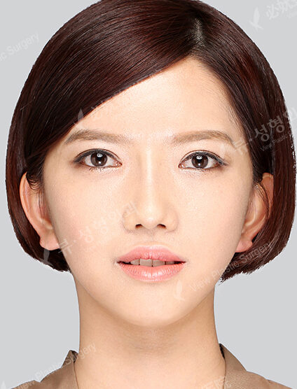 Nano Two Jaw+Natural Vline+Zygoma Reduction+Forehead Implant+Rhinoplasty+Ptosis (3 Months) — After
