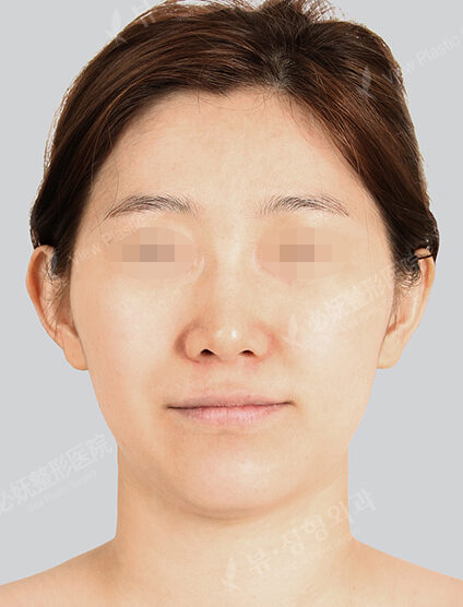 Nano Two Jaw+Natural Vline+Zygoma Reduction (7 Months) — Before