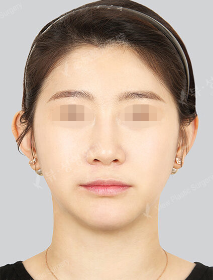 Nano Two Jaw+Natural Vline+Zygoma Reduction (7 Months) — After