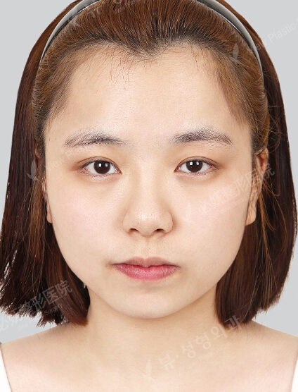 Protruding Mouth+Natural Vline+Zygoma Reduction+Forehead , Frontal Cheeks Fat Graft (27 Months) — Before