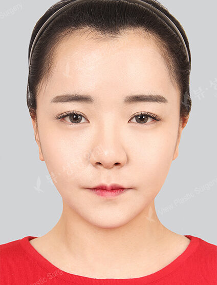 Protruding Mouth+Natural Vline+Zygoma Reduction+Forehead , Frontal Cheeks Fat Graft (27 Months) — After