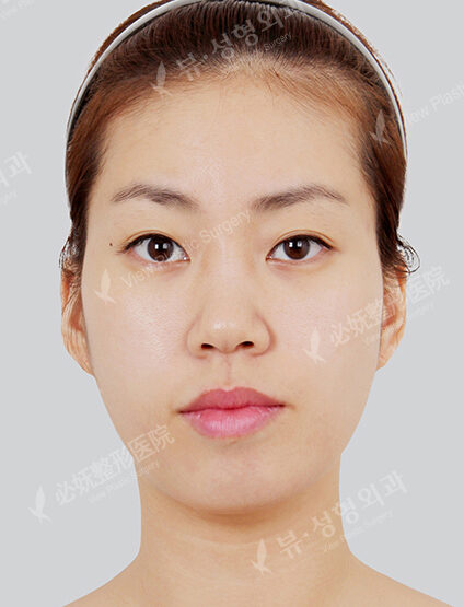 Nano Two Jaw+Natural Vline+Zygoma Reduction+Rhinoplasty (5 Months) — Before