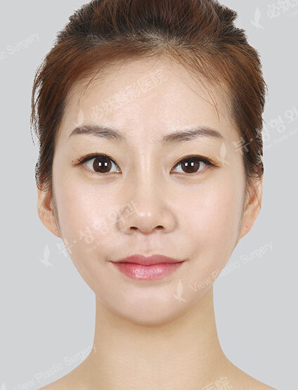 Nano Two Jaw+Natural Vline+Zygoma Reduction+Rhinoplasty (5 Months) — After