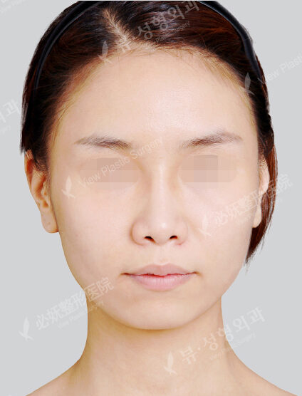 Protruding Mouth+Doll Line (Vline)(3 Months) — Before