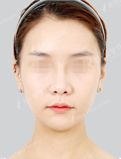 Protruding Mouth+Doll Line (Vline)(3 Months) — After