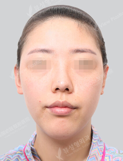 Two Jaw+Doll Line (Vline)+ Zygoma Reduction+Transconjuntival fat removal+Forehead Fat Graft (2 Months) — Before