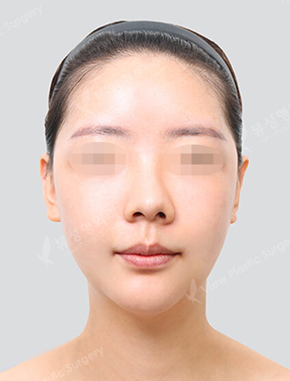 Two Jaw+Doll Line (Vline)+ Zygoma Reduction+Transconjuntival fat removal+Forehead Fat Graft (2 Months) — After