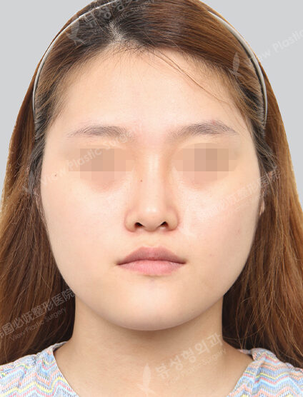 Nano Two Jaw+Natural Vline+Zygoma Reduction (19 Months) — Before