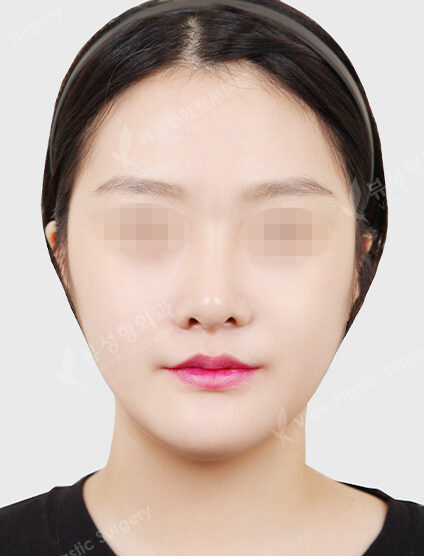 Nano Two Jaw+Natural Vline+Zygoma Reduction (19 Months) — After