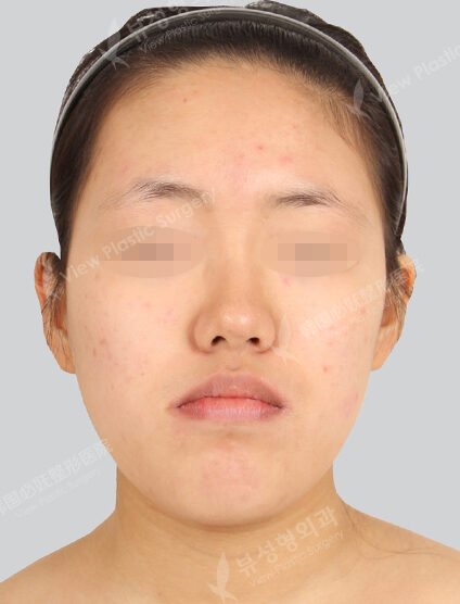Natural Vline+Zygoma Reduction (20 Months) — Before