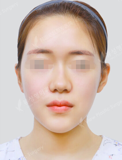 Natural Vline+Zygoma Reduction (20 Months) — After