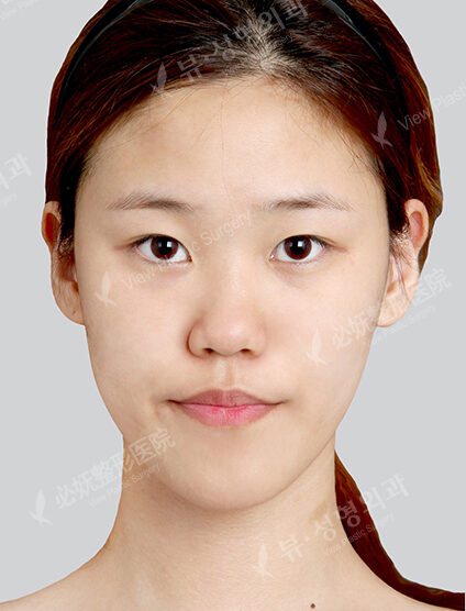 Nano Two Jaw+Natural Vline+Zygoma Reduction+Forehead Implant+Rhinoplasty+Fat Graft (12 Months) — Before