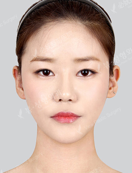 Nano Two Jaw+Natural Vline+Zygoma Reduction+Forehead Implant+Rhinoplasty+Fat Graft (12 Months) — After