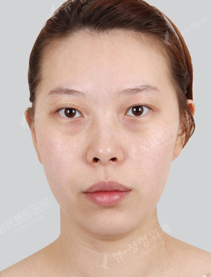 Protruding Mouth+Natural Vline+Forehead Implant+Frontal Cheek Implant+Burial+Lateral Canthoplasty+Transconjuntival fat removal(3 Months) — Before