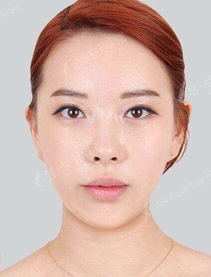 Protruding Mouth+Natural Vline+Forehead Implant+Frontal Cheek Implant+Burial+Lateral Canthoplasty+Transconjuntival fat removal(3 Months) — After