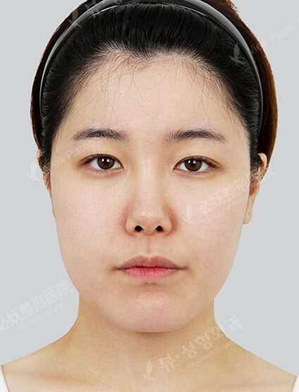 Nano Two Jaw+Natural Vline+Zygoma Reduction+Revisional Eye Surgery (15 Months) — Before
