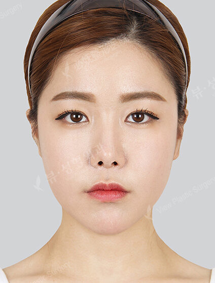 Nano Two Jaw+Natural Vline+Zygoma Reduction+Revisional Eye Surgery (15 Months) — After