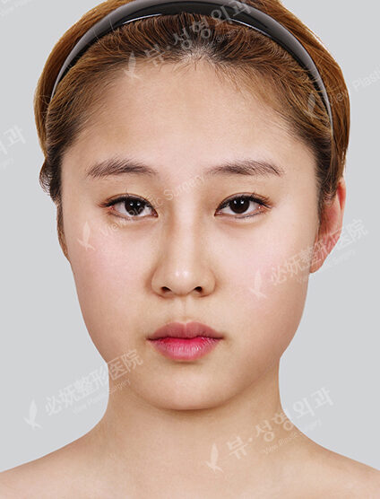 Nano Two Jaw+Doll Line+Zygoma Reduction+Forehead Implant+Frontal Cheek Implant+Combination Ptosis Correction Surgery+Rhinoplasty (5 Months) — Before