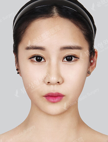 Nano Two Jaw+Doll Line+Zygoma Reduction+Forehead Implant+Frontal Cheek Implant+Combination Ptosis Correction Surgery+Rhinoplasty (5 Months) — After