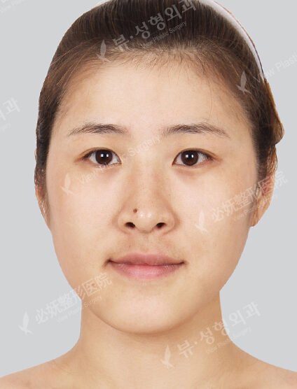 Nano Two Jaw+Natural Vline+Zygoma Reduction+Forehead Implant+Frontal Cheek Implant+Combination Ptosis Correction Surgery+Epicanthoplasty+Rhinoplasty (7 Months) — Before