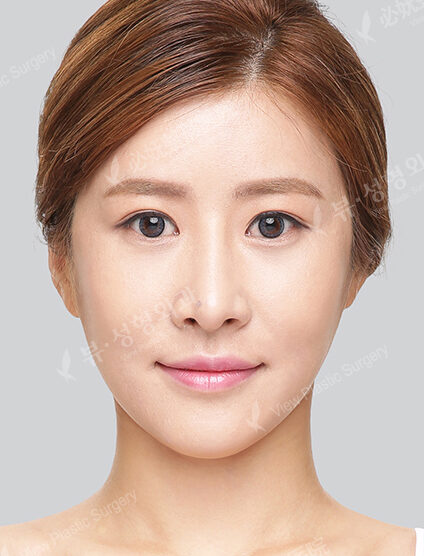 Nano Two Jaw+Natural Vline+Zygoma Reduction+Forehead Implant+Frontal Cheek Implant+Combination Ptosis Correction Surgery+Epicanthoplasty+Rhinoplasty (7 Months) — After