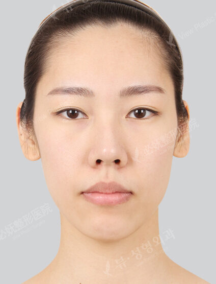 Nano Two Jaw+Natural Vline+Zygoma Reduction+Genioplasty(4 Months) — Before