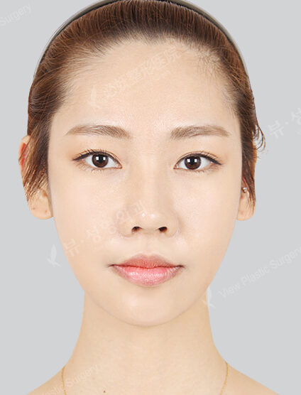 Nano Two Jaw+Natural Vline+Zygoma Reduction+Genioplasty(4 Months) — After