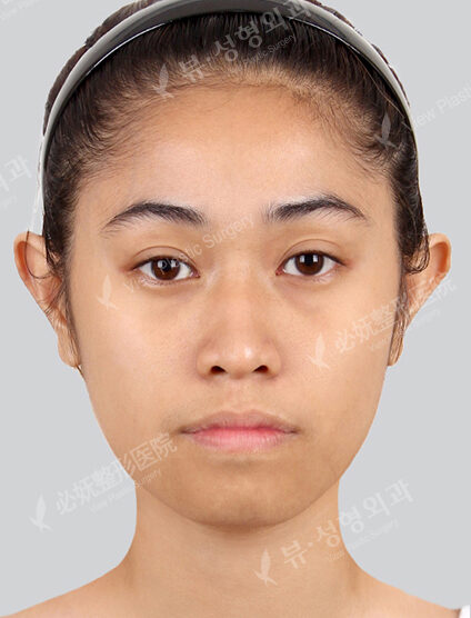 Nano Two Jaw+Natural Vline+Zygoma Reduction+Forehead Fat Graft+Rhinoplasty+Ear Surgery (3 Months) — Before