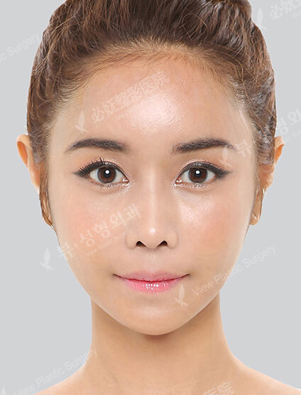 Nano Two Jaw+Natural Vline+Zygoma Reduction+Forehead Fat Graft+Rhinoplasty+Ear Surgery (3 Months) — After