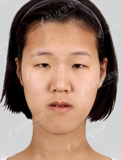 Nano Two Jaw+Doll Line (Vline)+ Zygoma Reduction+Forehead Implant+Anterior Cheekbones Implant +Rhinoplasty+Fat Graft (3 Months) — Before