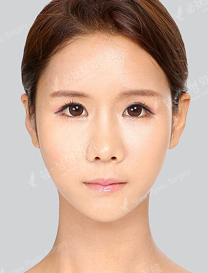 Nano Two Jaw+Doll Line (Vline)+ Zygoma Reduction+Forehead Implant+Anterior Cheekbones Implant +Rhinoplasty+Fat Graft (3 Months) — After