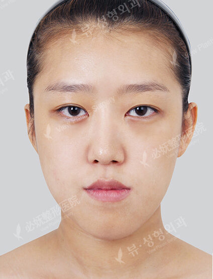 Nano Two Jaw+Natural Vline+Zygoma Reduction+Forehead Implant+Frontal Cheek Implant+Rhinoplasty+Fat Graft (8 Months ) — Before