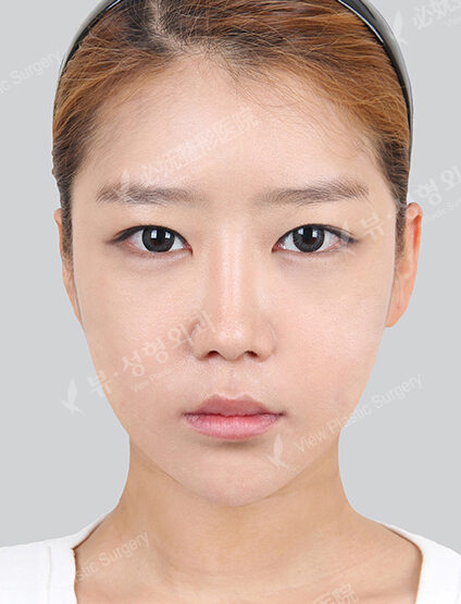 Nano Two Jaw+Natural Vline+Zygoma Reduction+Forehead Implant+Frontal Cheek Implant+Rhinoplasty+Fat Graft (8 Months ) — After