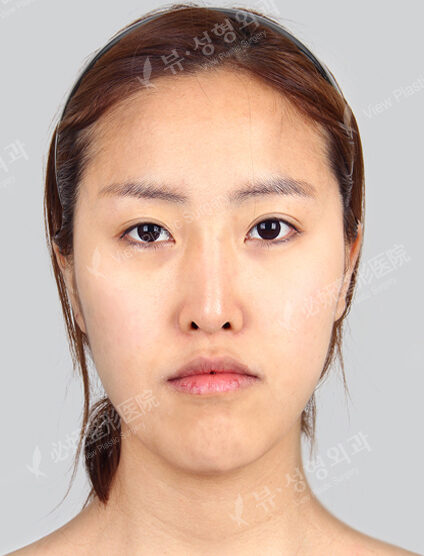 Nano Two Jaw+Natural Line (Angular Jaw+Front Chin)+ Cheekbone+Frontal Cheeks (Implant)+ Combination Ptosis Correction Surgery (Revisional Surgery)_11 Months — Before