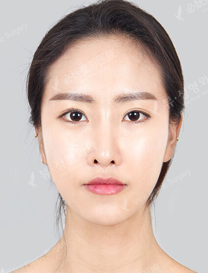 Nano Two Jaw+Natural Line (Angular Jaw+Front Chin)+ Cheekbone+Frontal Cheeks (Implant)+ Combination Ptosis Correction Surgery (Revisional Surgery)_11 Months — After