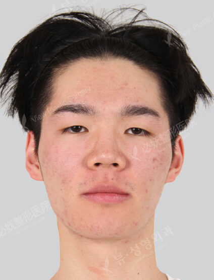 Two Jaw+Natural Vline+Zygoma Reduction+Combination Ptosis Correction Surgery (6 Months) — Before