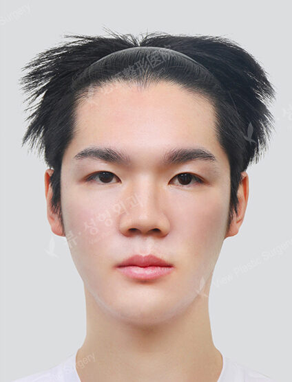 Two Jaw+Natural Vline+Zygoma Reduction+Combination Ptosis Correction Surgery (6 Months) — After